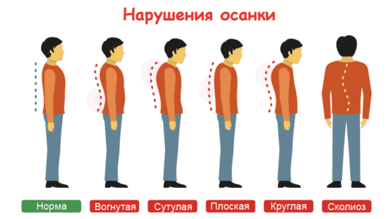 нарушения осанки в Ровно