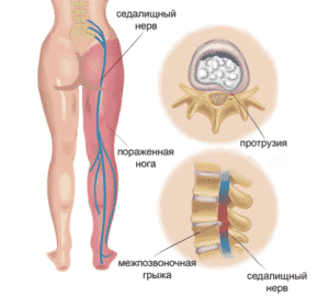 Лечение ишиаса в Ровно