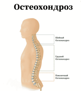 Лечение остеохондроза (ДДПП) в Ровно