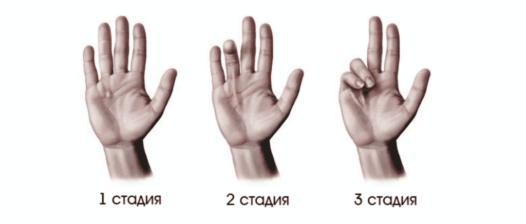 контрактура в Ровно