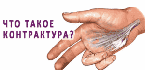 Лечение контрактуры в Ровно