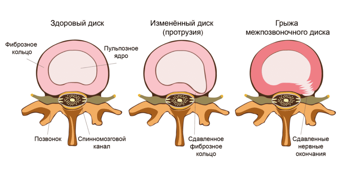 грыжи ровно